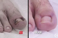 Ноготь Кулявый